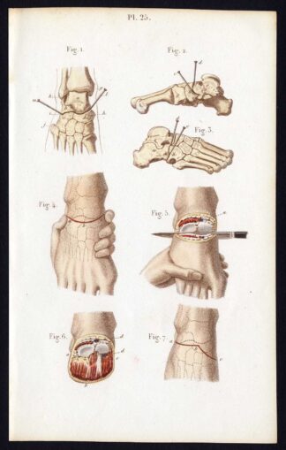 Antique Print-SURGERY-DISARTICULATION-TRANSVERSE TARSAL-Bernard-Davesne-1846