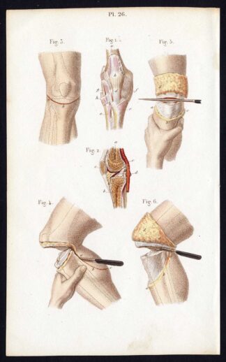 Antique Print-SURGERY-DISARTICULATION-TIBIOFEMORAL JOINT-Bernard-Davesne-1846