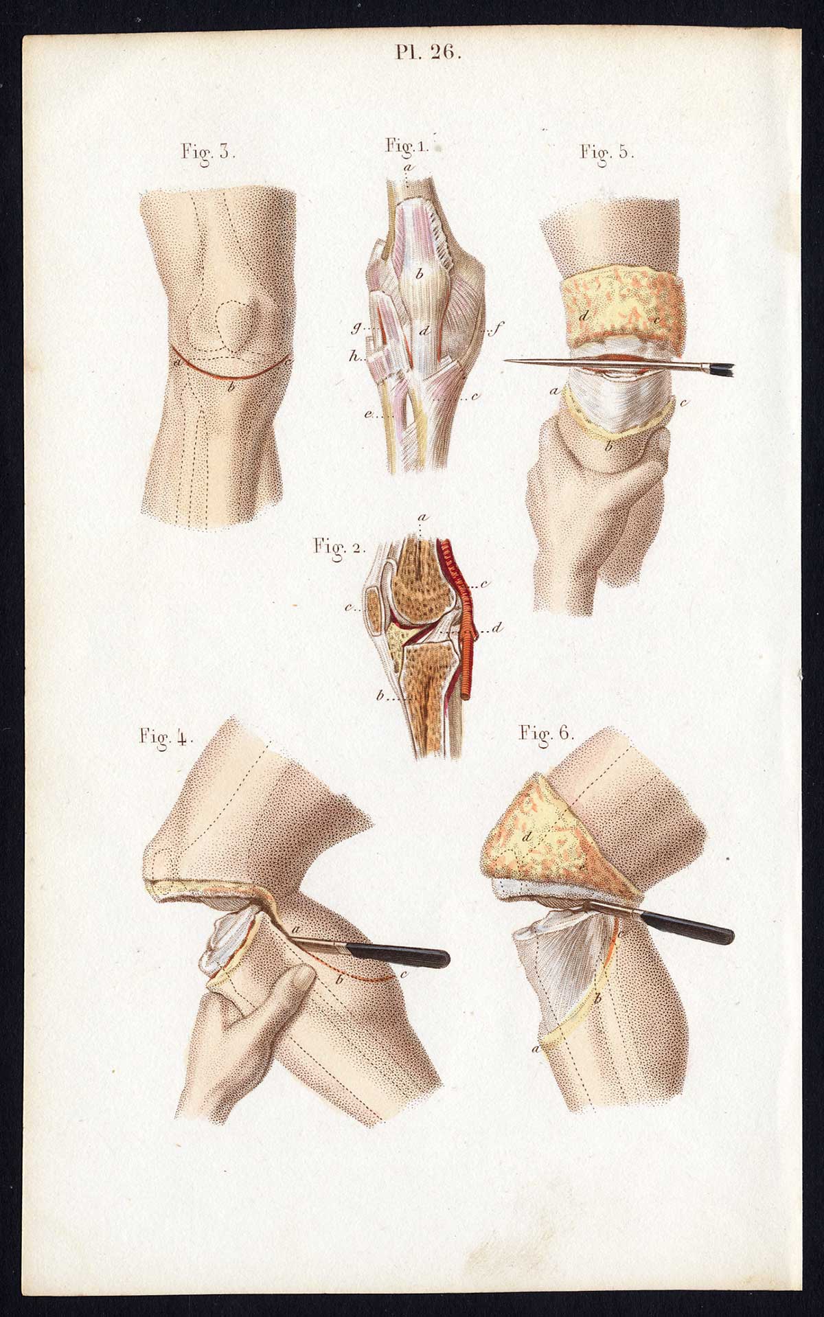 , Antique Print-SURGERY-DISARTICULATION-TIBIOFEMORAL JOINT-Bernard-Davesne-1846, Pictura Antique Prints