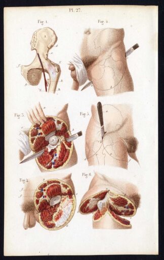 Antique Print-SURGERY-DISARTICULATION-THIGH-GENITALS-Bernard-Davesne-1846