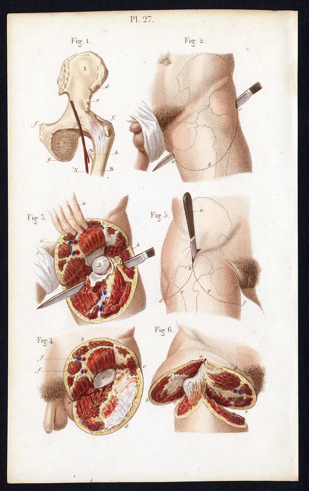 , Antique Print-SURGERY-DISARTICULATION-THIGH-GENITALS-Bernard-Davesne-1846, Pictura Antique Prints