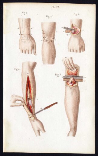 Antique Print-SURGERY-RESECTION-SEGMENTECTOMY-ARM-OPERATION-Bernard-Davesne-1846