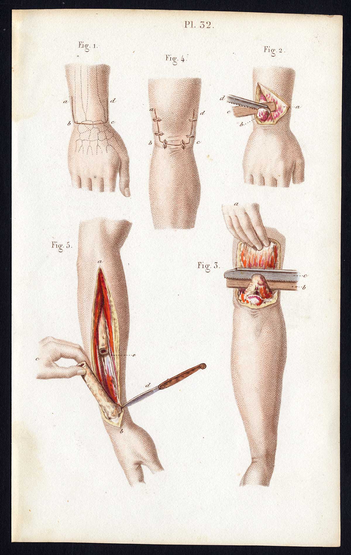 , Antique Print-SURGERY-RESECTION-SEGMENTECTOMY-ARM-OPERATION-Bernard-Davesne-1846, Pictura Antique Prints