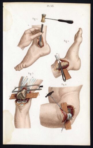 Antique Print-SURGERY-RESECTION-SEGMENTECTOMY-LEG-OPERATION-Bernard-Davesne-1846