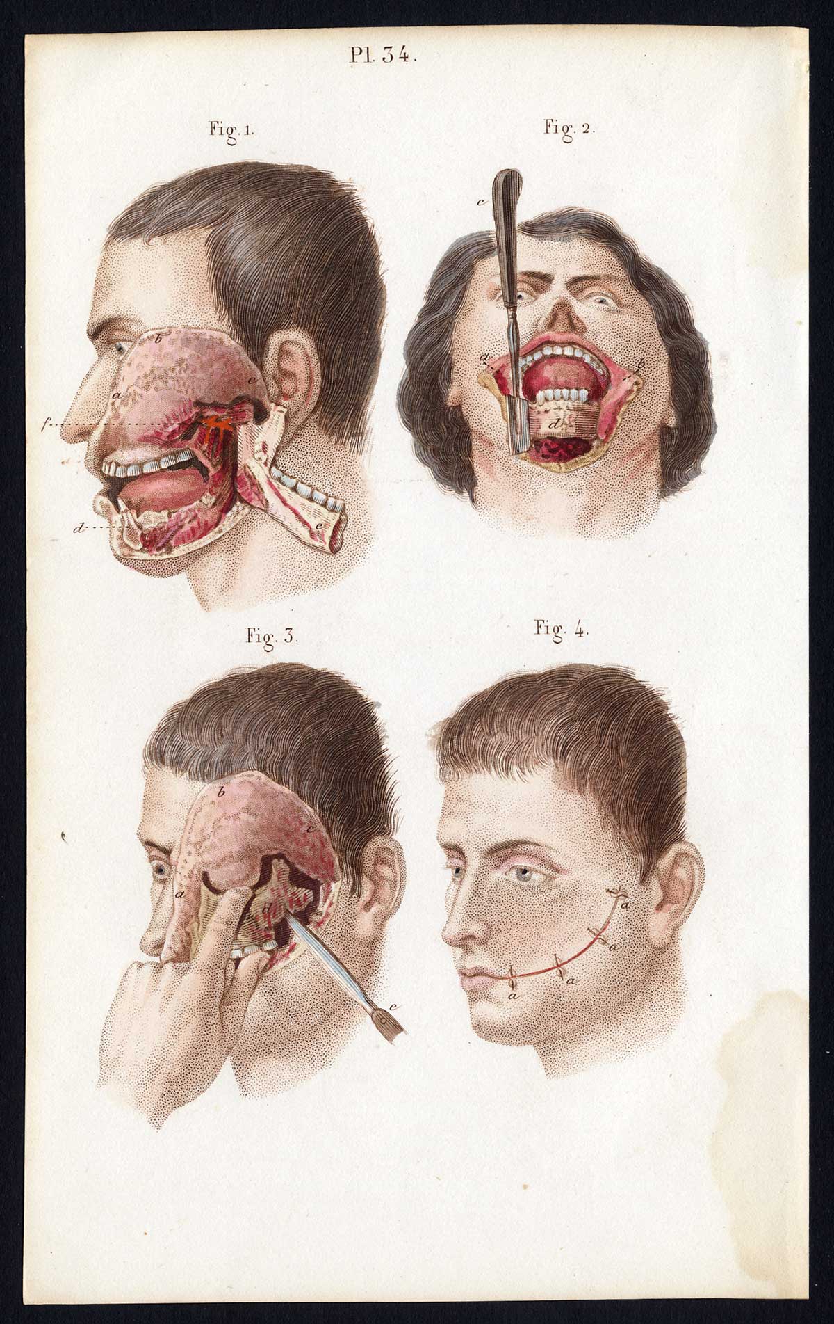 Jb284 416x660 Antique Print-SURGERY-RESECTION-SEGMENTECTOMY-JAW-OPERATION-Bernard-Davesne-1846