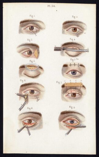 2 Antique Prints-SURGERY-EYELIDS-OPERATION-Bernard-Davesne-1846