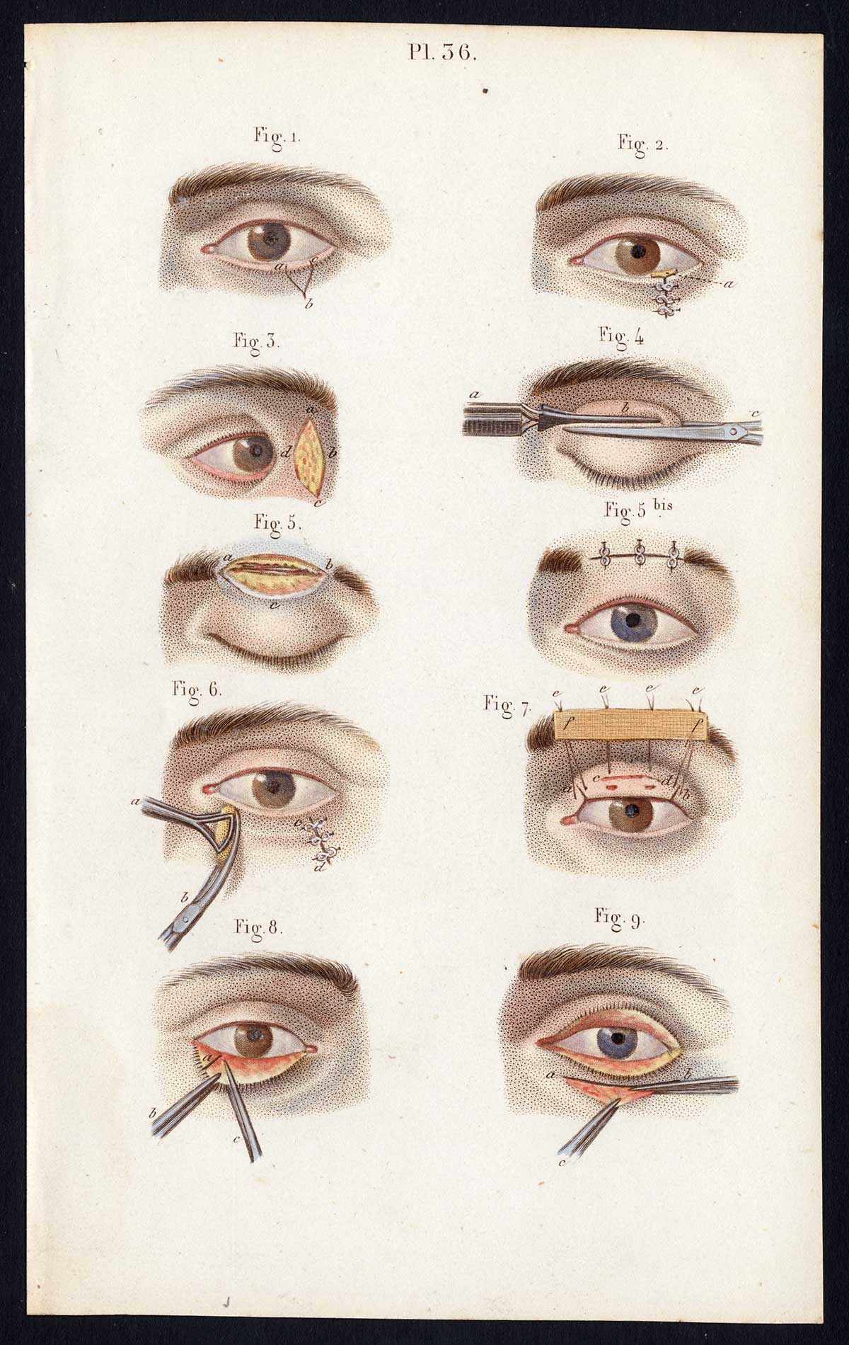 , 2 Antique Prints-SURGERY-EYELIDS-OPERATION-Bernard-Davesne-1846, Pictura Antique Prints