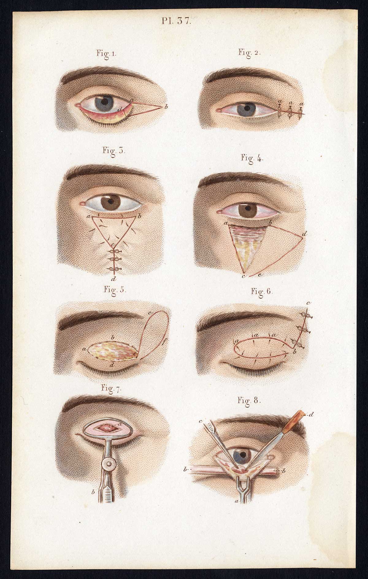 , 2 Antique Prints-SURGERY-EYELIDS-OPERATION-Bernard-Davesne-1846, Pictura Antique Prints