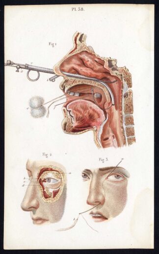 2 Antique Prints-SURGERY-LACRYMAL APPARATUS-EYE-OPERATION-Bernard-Davesne-1846