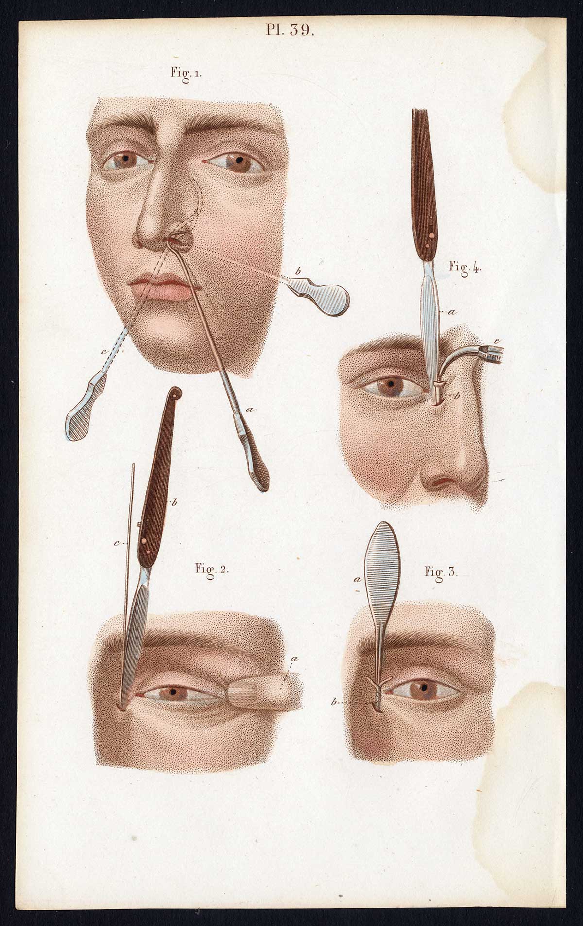 , 2 Antique Prints-SURGERY-LACRYMAL APPARATUS-EYE-OPERATION-Bernard-Davesne-1846, Pictura Antique Prints
