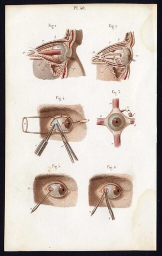 Antique Print-SURGERY-STRABISMUS-EYE MUSCLES-OPERATION-Bernard-Davesne-1846