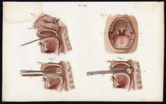 Antique Print-SURGERY-AMYGDALA-ABLATION-POLYP-LIGATURE-Bernard-Davesne-1846