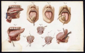 Antique Print-SURGERY-OPERATION-TONGUE CANCER-MOUTH-Bernard-Davesne-1846