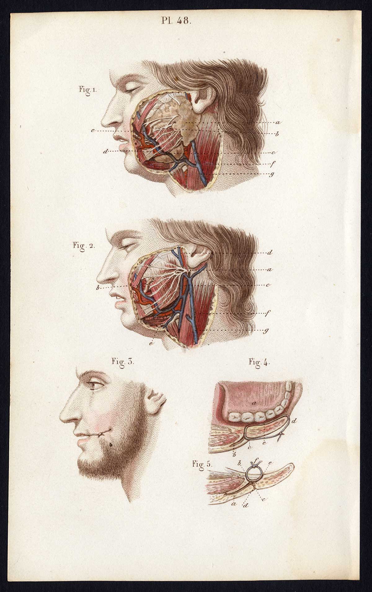 , Antique Print-SURGERY-OPERATION-SALIVARY SYSTEM-GLAND-Bernard-Davesne-1846, Pictura Antique Prints