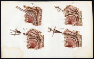 3 Antique Prints-SURGERY-OPERATION-ESOPHAGUS-GOITRE-Bernard-Davesne-1846
