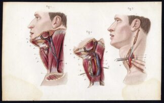 Antique Print-SURGERY-OPERATION-ESOPHAGUS-ESOPHAGOSTOMY-Bernard-Davesne-1846