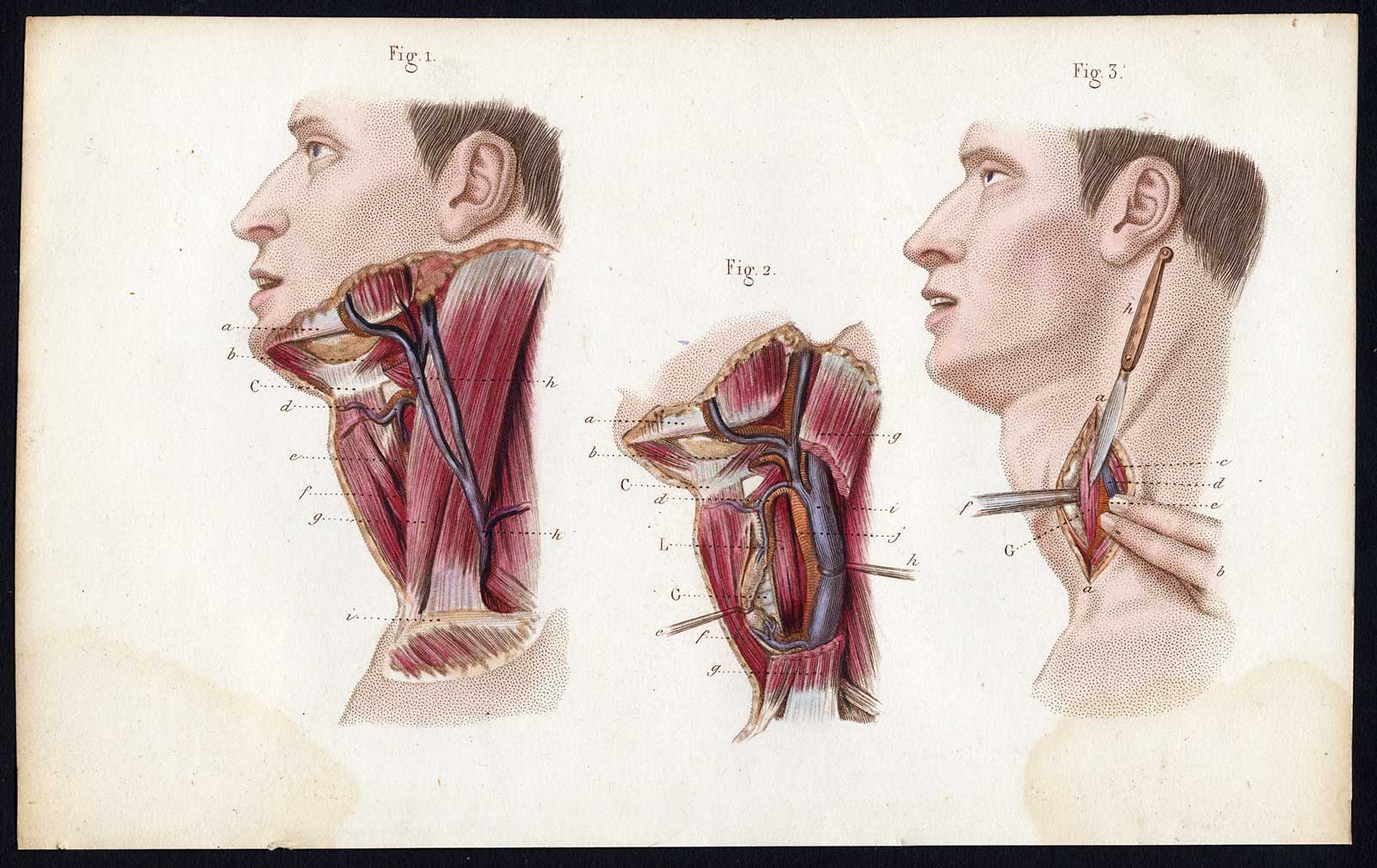 , Antique Print-SURGERY-OPERATION-ESOPHAGUS-ESOPHAGOSTOMY-Bernard-Davesne-1846, Pictura Antique Prints