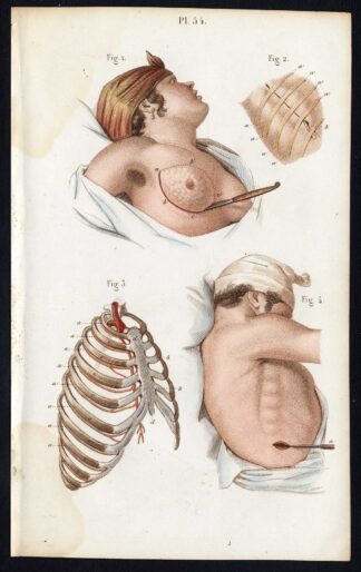 3 Antique Prints-SURGERY-OPERATION-MASTECTOMY-ABDOMEN-Bernard-Davesne-1846