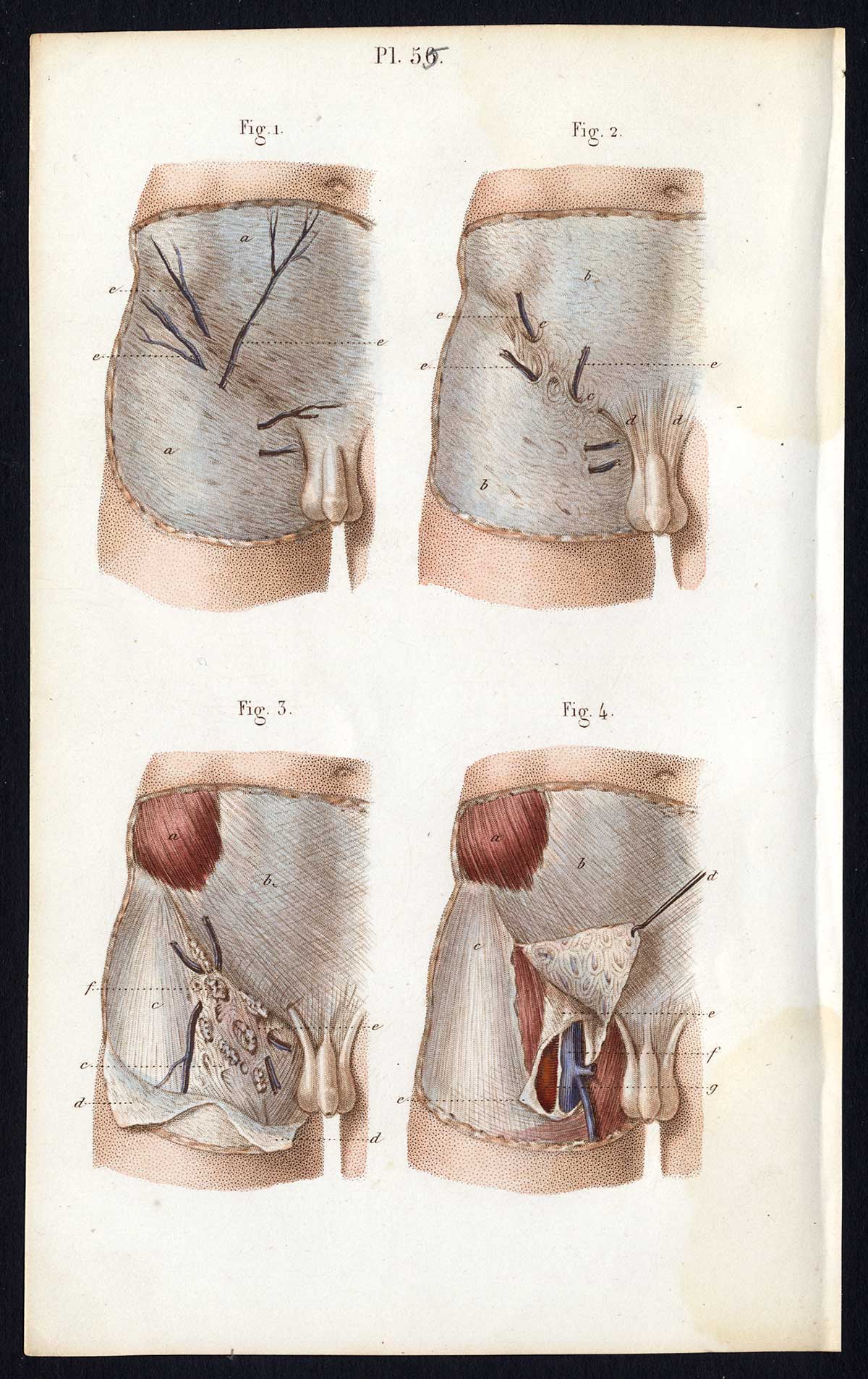 , 2 Antique Prints-SURGERY-OPERATION-HERNIA-GENITALS-ABDOMEN-Bernard-Davesne-1846, Pictura Antique Prints
