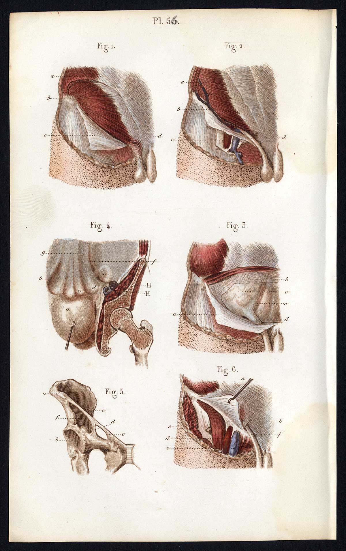 , 2 Antique Prints-SURGERY-OPERATION-HERNIA-GENITALS-ABDOMEN-Bernard-Davesne-1846, Pictura Antique Prints