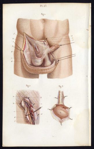 Antique Print-SURGERY-OPERATION-SCROTUM-GENITALS-TESTICLES-Bernard-Davesne-1846