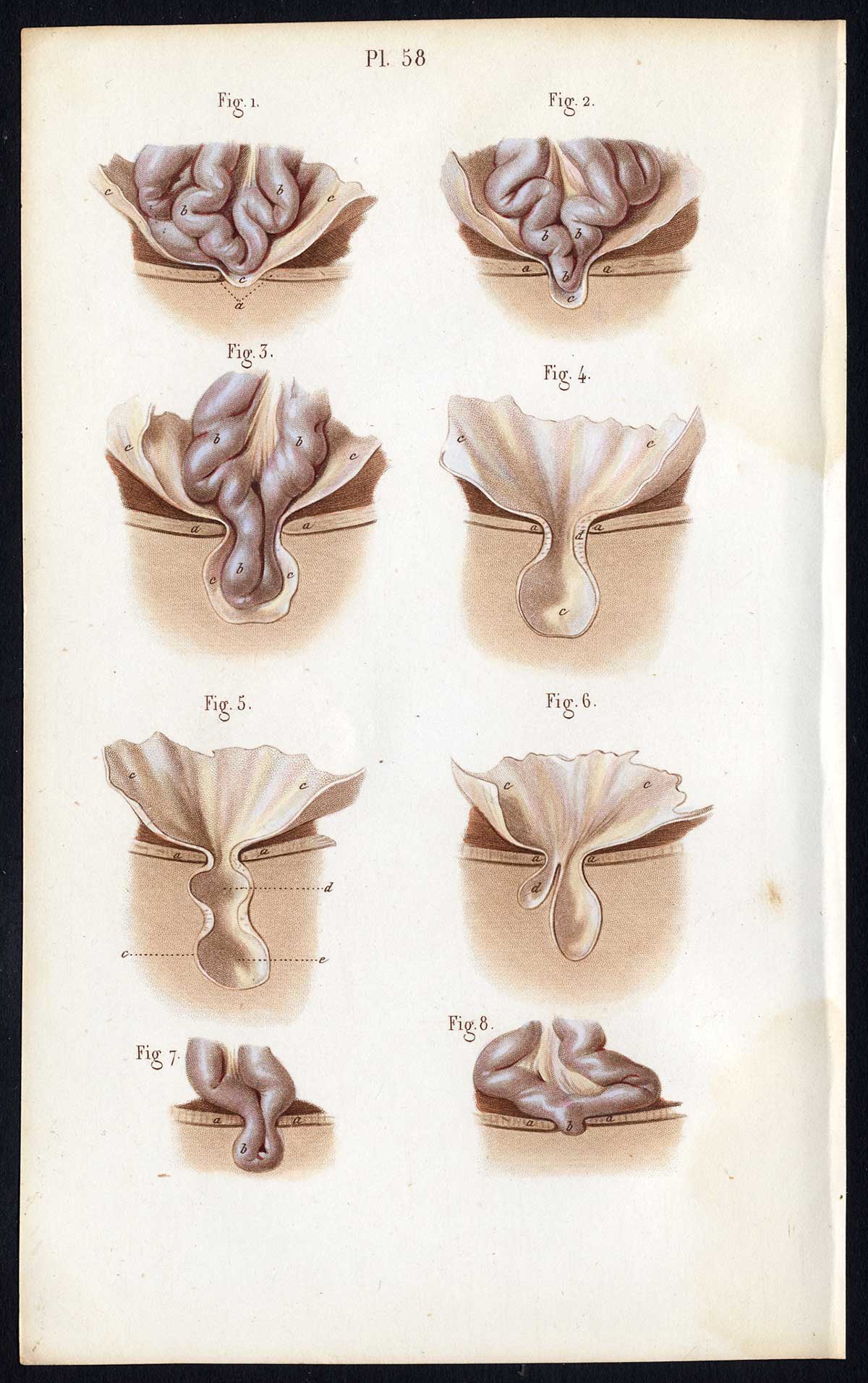, Antique Print-SURGERY-OPERATION-INGUINAL HERNIA-INTESTINES-Bernard-Davesne-1846, Pictura Antique Prints