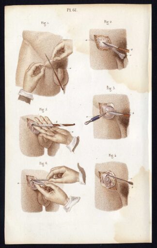 Antique Print-SURGERY-OPERATION-DEBRIDEMENT-ABDOMEN-TISSUE-Bernard-Davesne-1846