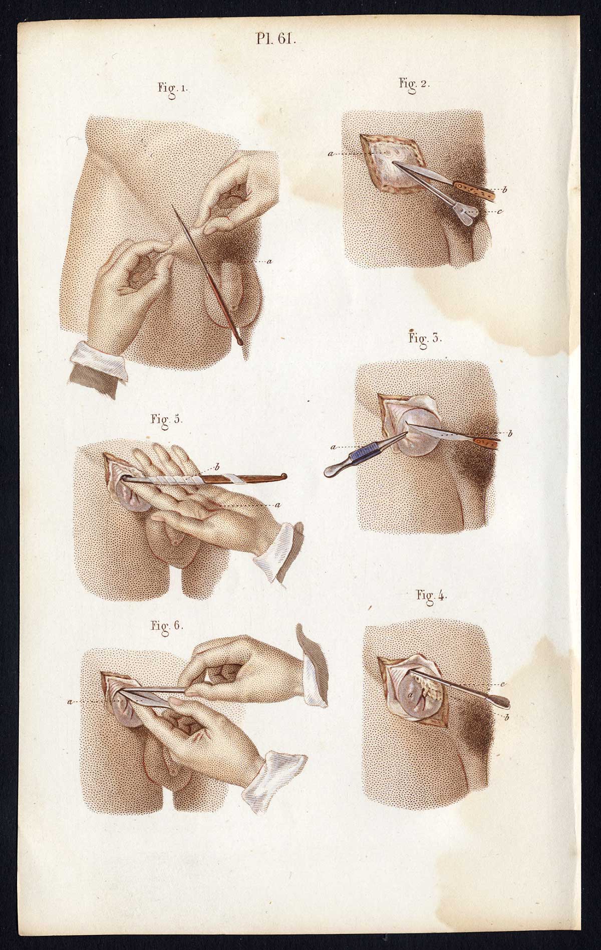 , Antique Print-SURGERY-OPERATION-DEBRIDEMENT-ABDOMEN-TISSUE-Bernard-Davesne-1846, Pictura Antique Prints