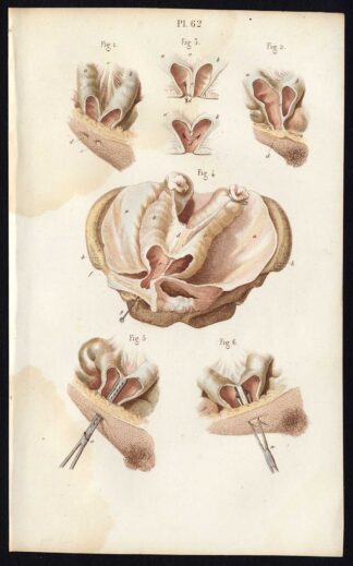 3 Antique Prints-SURGERY-OPERATION-RECTUM-ANUS-INTESTINES-Bernard-Davesne-1846