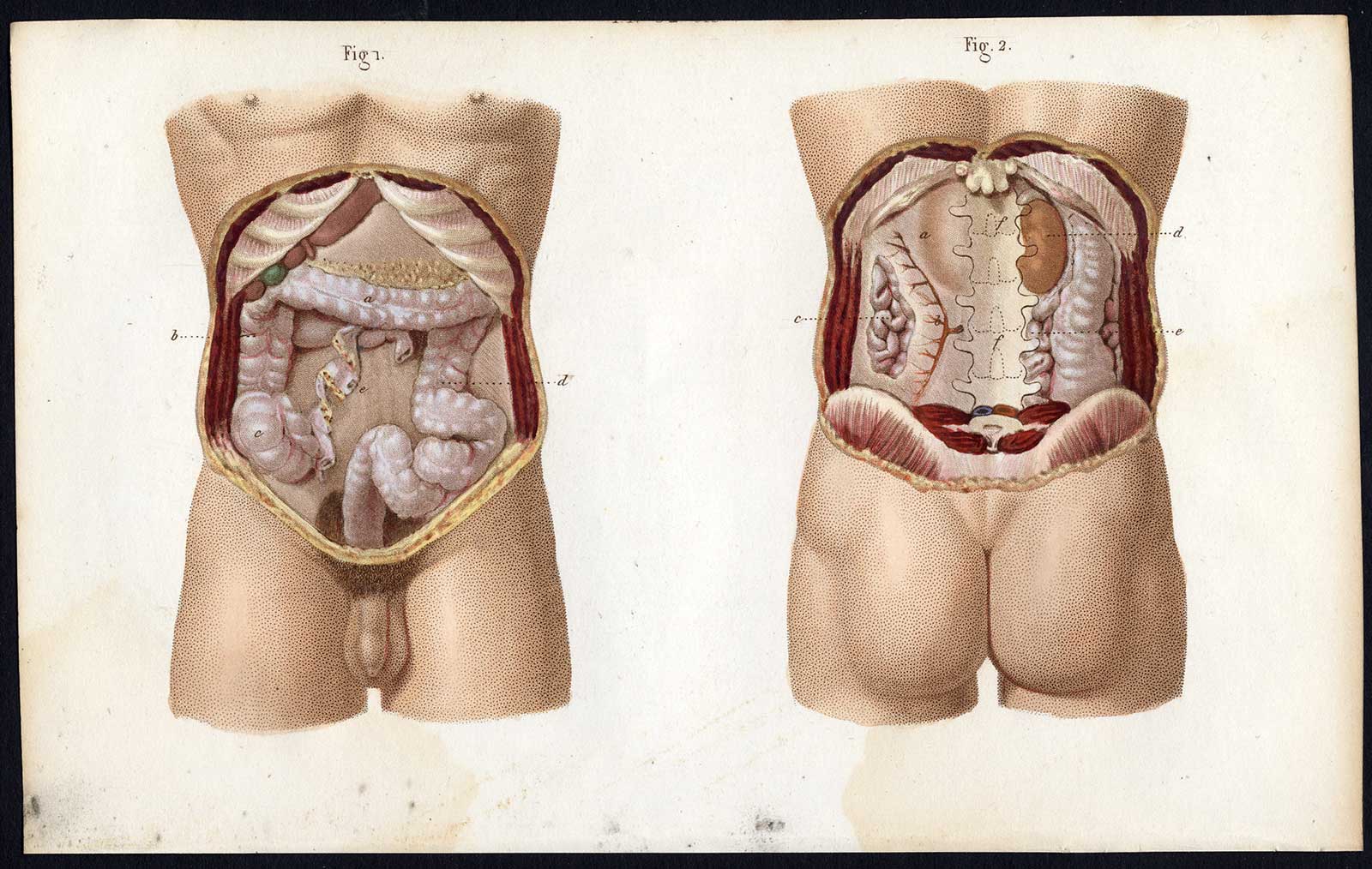 , 3 Antique Prints-SURGERY-OPERATION-RECTUM-ANUS-INTESTINES-Bernard-Davesne-1846, Pictura Antique Prints