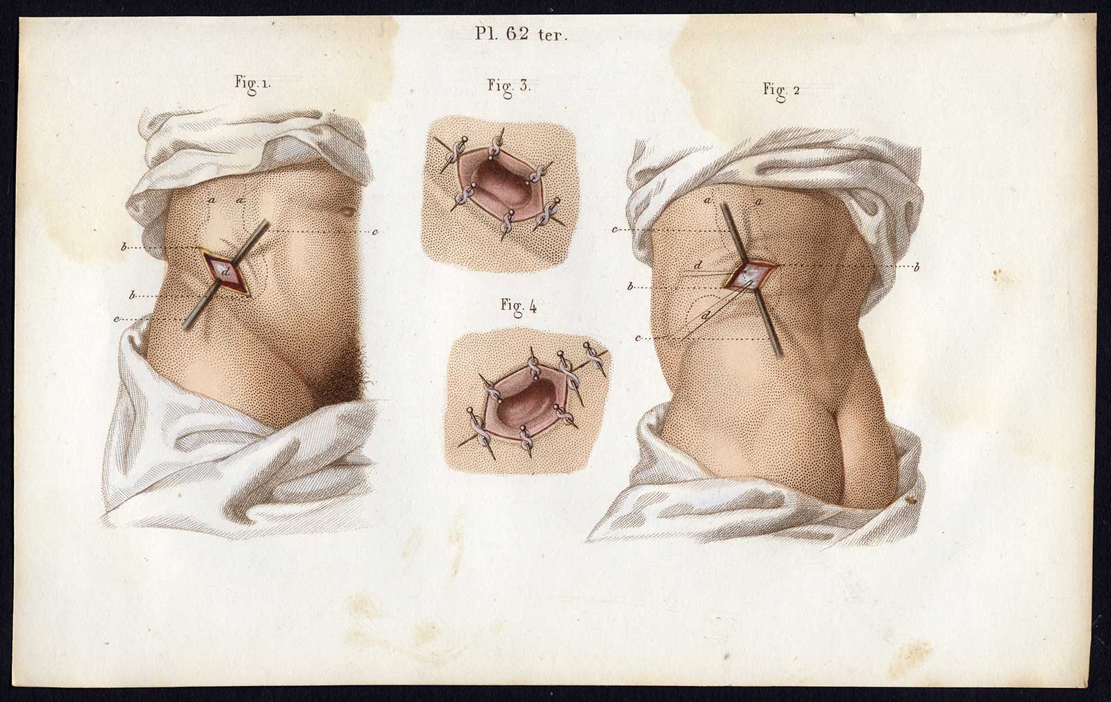 , 3 Antique Prints-SURGERY-OPERATION-RECTUM-ANUS-INTESTINES-Bernard-Davesne-1846, Pictura Antique Prints