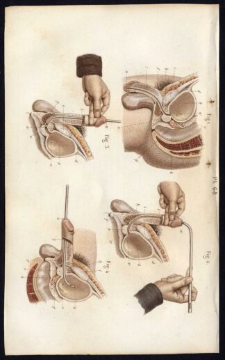 Antique Print-SURGERY-OPERATION-URINARY BLADDER-URETHRA-II-Bernard-Davesne-1846