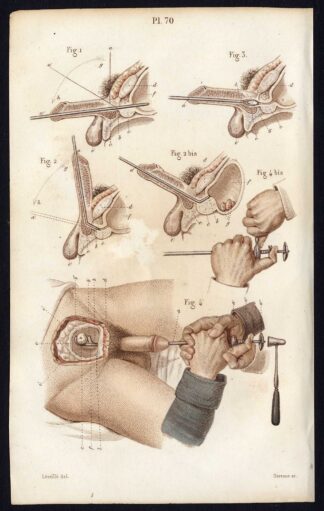 Antique Print-SURGERY-OPERATION-URINARY CATHETERIZATION-Bernard-Davesne-1846