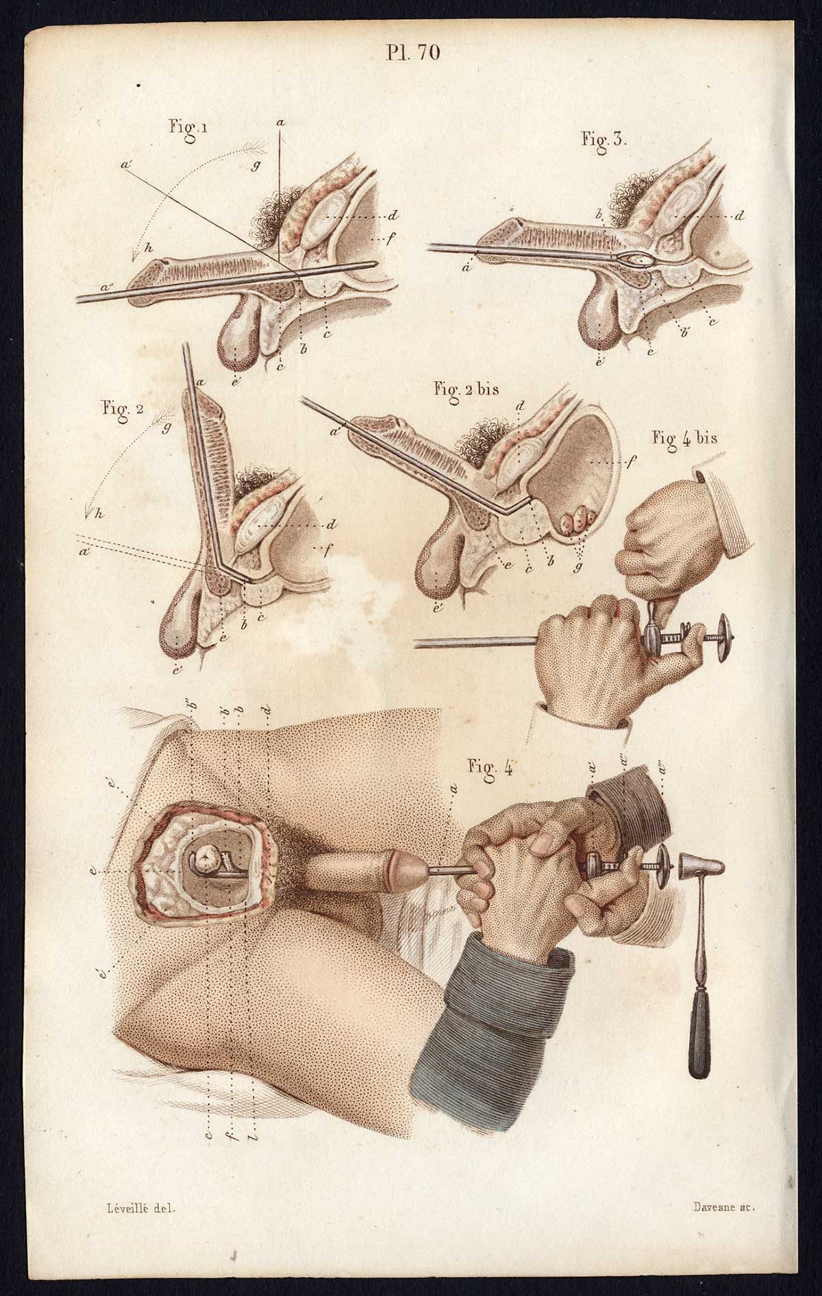 Jb320 416x656 Antique Print-SURGERY-OPERATION-URINARY CATHETERIZATION-Bernard-Davesne-1846