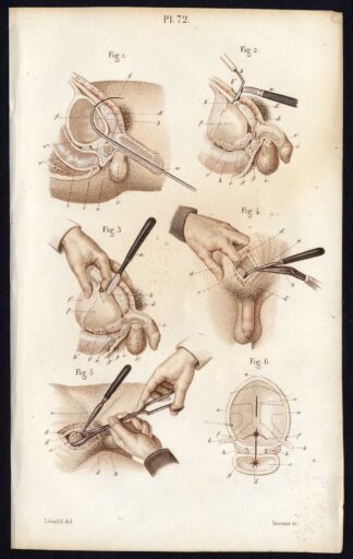 Antique Print-SURGERY-OPERATION-HYPOGASTRIC REGION-PENIS-Bernard-Davesne-1846