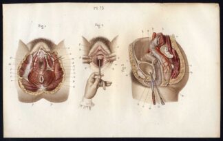 Antique Print-SURGERY-OPERATION-FEMALE ANATOMY-VAGINA-Bernard-Davesne-1846