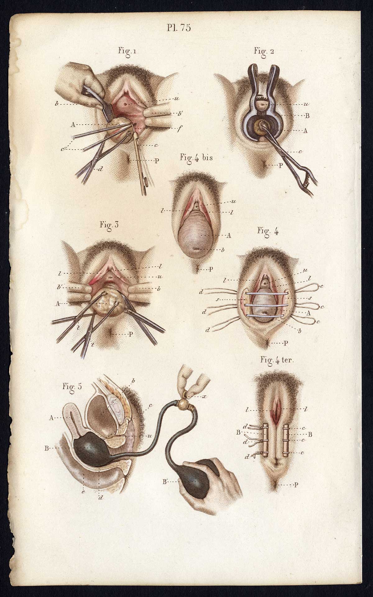 Jb325 416x665 Antique Print-SURGERY-OPERATION-UTERUS-POLYP-CERVIX-VAGINA-Bernard-Davesne-1846
