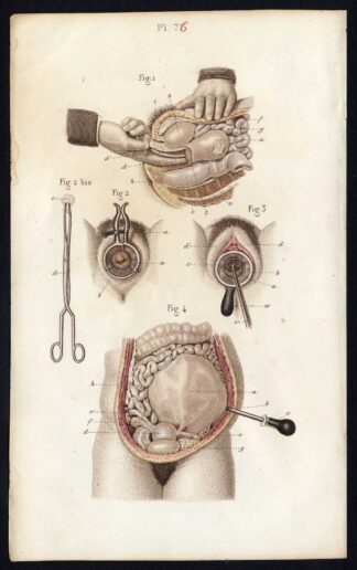 Antique Print-SURGERY-OPERATION-UTERUS-CERVIX-VAGINA-Bernard-Davesne-1846