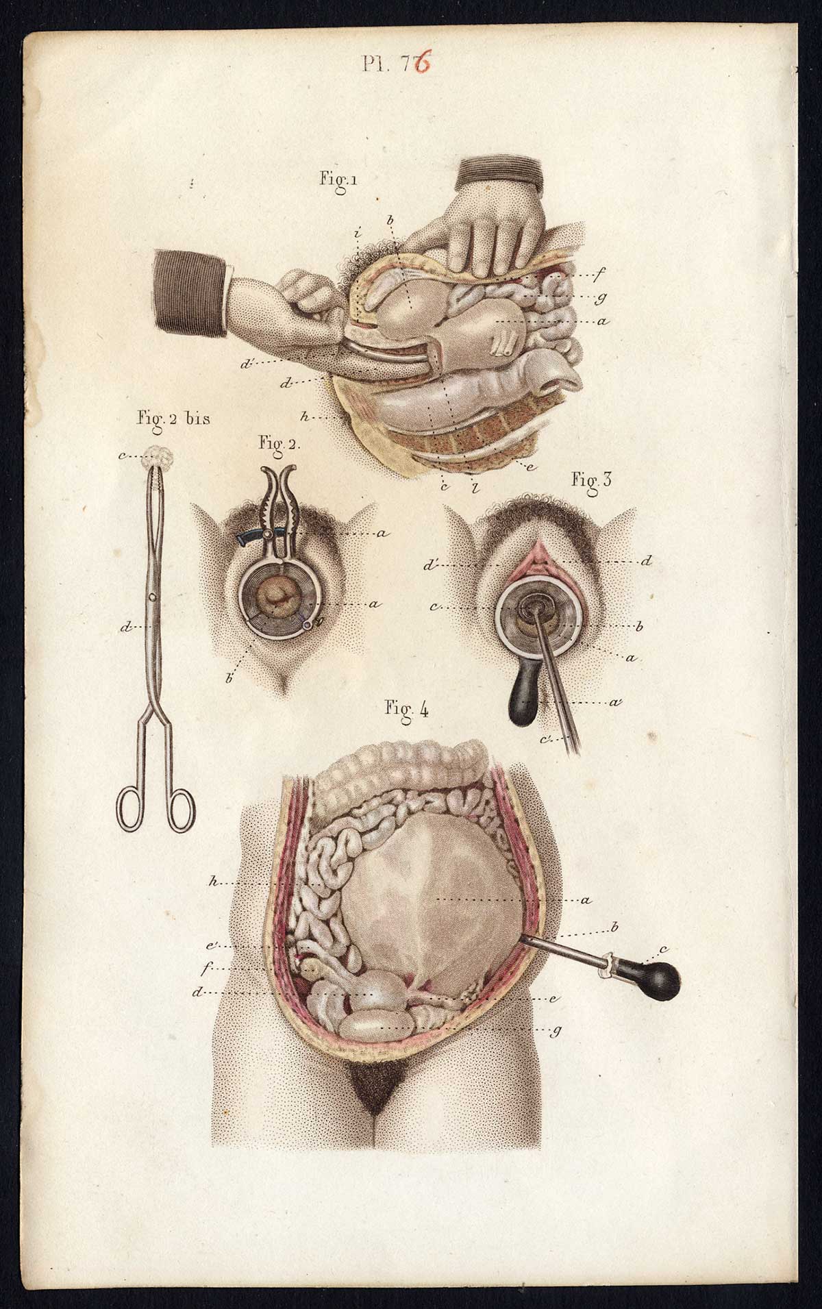 , Antique Print-SURGERY-OPERATION-UTERUS-CERVIX-VAGINA-Bernard-Davesne-1846, Pictura Antique Prints