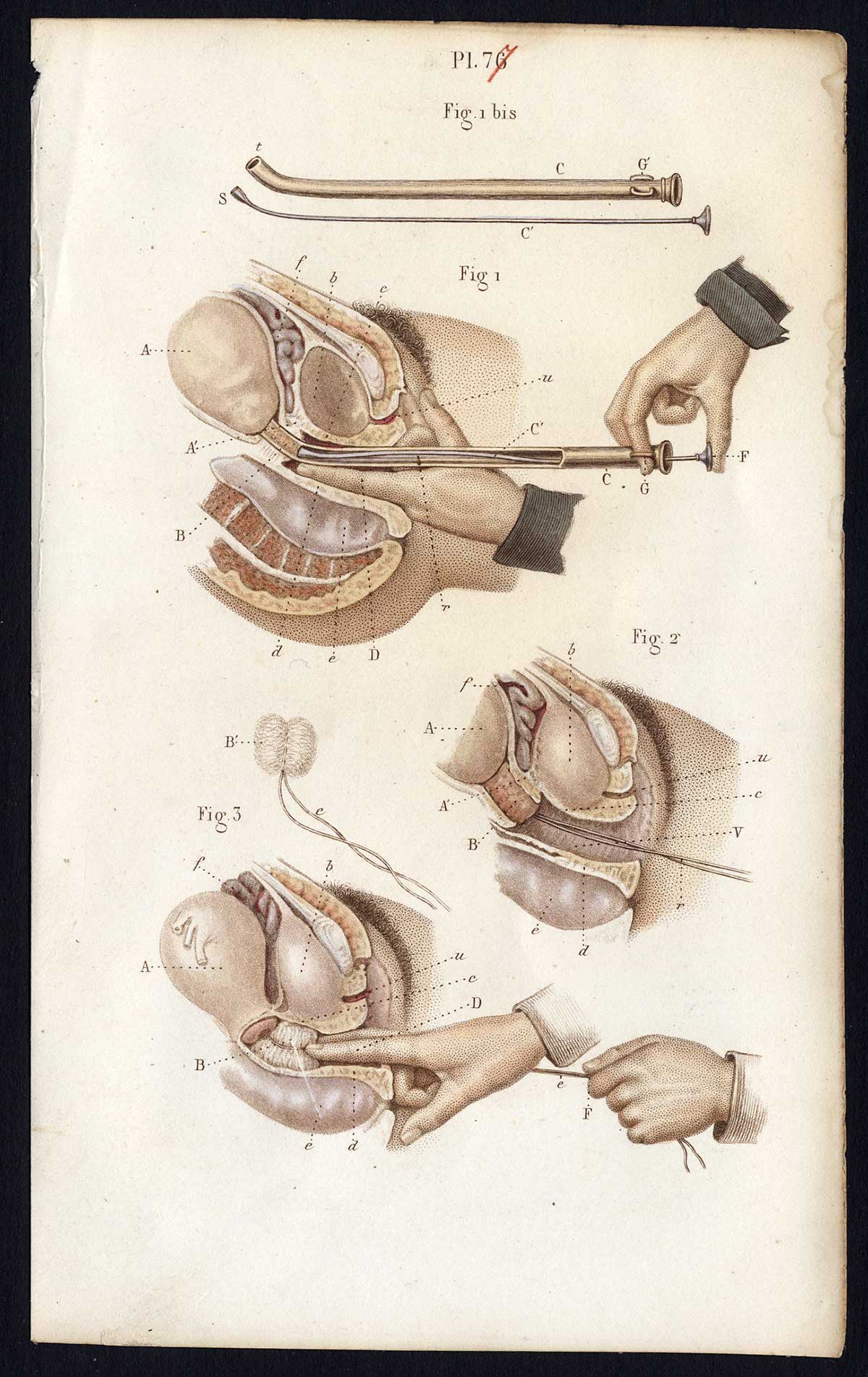 Jb327 416x659 Antique Print-SURGERY-PREGNANCY-CHILDBIRTH-PRETERM-UTERUS-Bernard-Davesne-1846