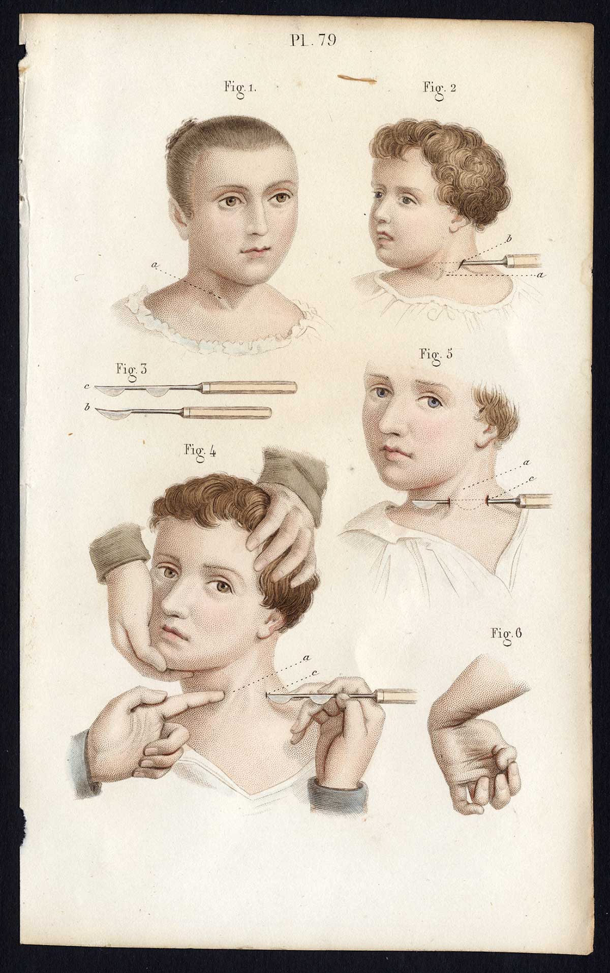 , Antique Print-SURGERY-TENOTOMY-TENDON-OPERATION-Bernard-Davesne-1846, Pictura Antique Prints