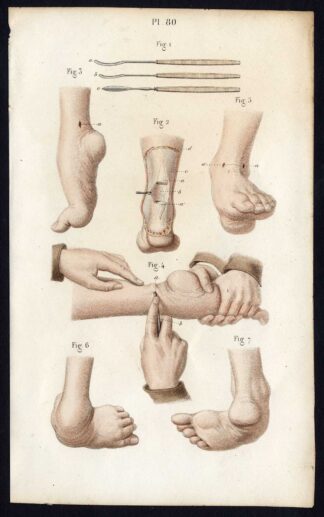 Antique Print-SURGERY-ACHILLES TENDON-CLUBFOOT-OPERATION-Bernard-Davesne-1846