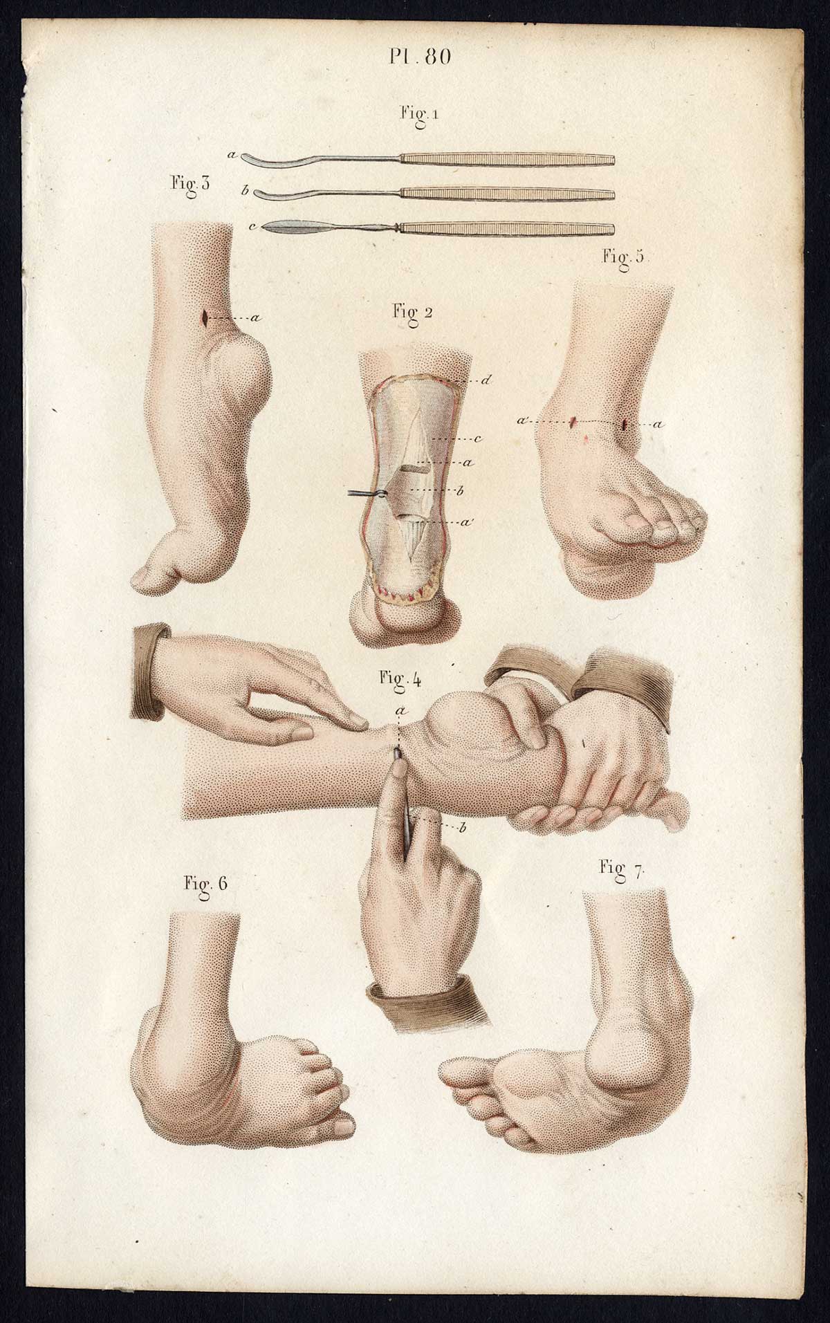, Antique Print-SURGERY-ACHILLES TENDON-CLUBFOOT-OPERATION-Bernard-Davesne-1846, Pictura Antique Prints