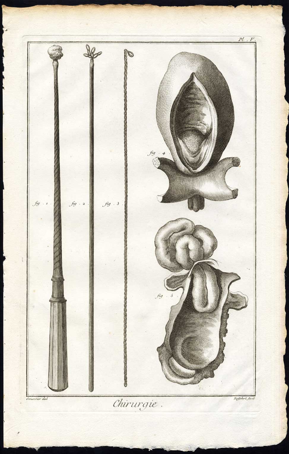 , Antique Print-SURGERY-MEDICAL INSTRUMENTS-ESOPHAGUS-Diderot-Defehrt-1751, Pictura Antique Prints