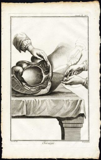 Antique Print-SURGERY-MEDICAL INSTRUMENT-HYPOGASTRIUM-Diderot-Prevost-1751