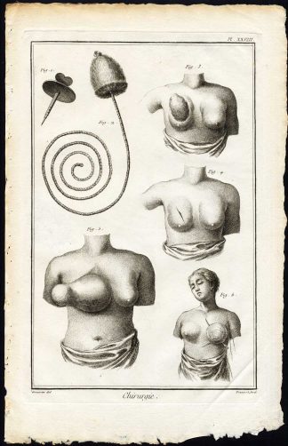 Antique Print-SURGERY-MEDICAL INSTRUMENT-BREAST CANCER-Diderot-Prevost-1751