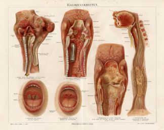 Antique Print-LARYNX-NECK-TRACHEA-DISEASE-Meyers-1895