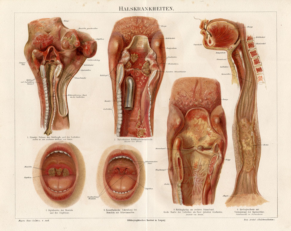 , Antique Print-LARYNX-NECK-TRACHEA-DISEASE-Meyers-1895, Pictura Antique Prints