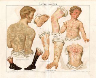 Antique Print-SKIN-MEASLES-ECZEMA-SCARLET-Meyers-1895