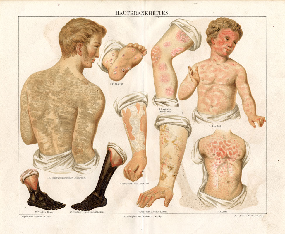 , Antique Print-SKIN-MEASLES-ECZEMA-SCARLET-Meyers-1895, Pictura Antique Prints